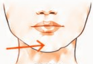 Chin Dimpling treatment area diagram