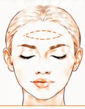 Forehead Lines treatment area diagram