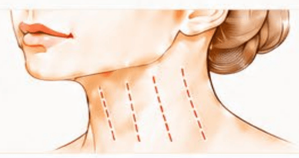 Platysmal bands (neck lines) treatment area diagram