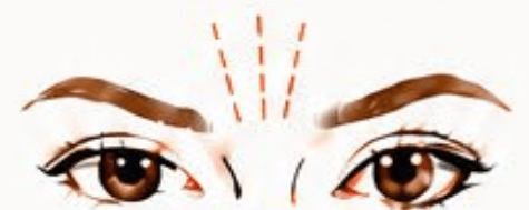 Frown Lines (Glabella) treatment area diagram
